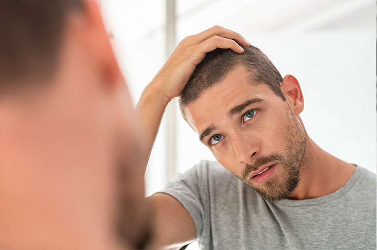 alopecia e caduta capelli